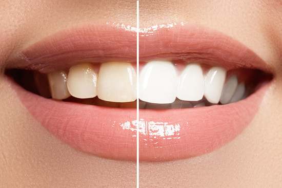 牙齿内侧有黄垢怎么办 除了洗牙这些办法可能会帮到你