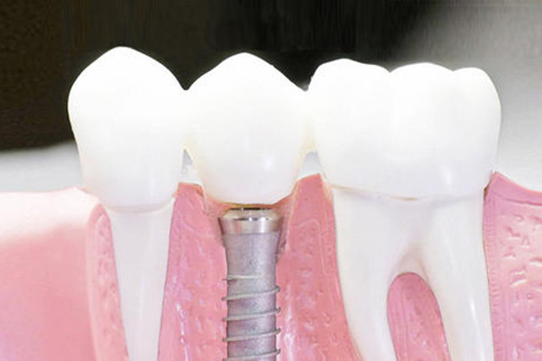 种植牙齿不能吃什么 种植牙齿后多久消肿