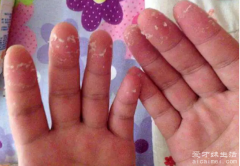 手脱皮是什么原因导致的及最佳治疗方法，干燥营养不良手癣或者水疱疹