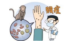 猴痘是什么病有什么症状，是DNA双链病毒(出现头痛/发热)