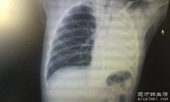 白肺的一个明显表现是气紧，氧饱和度低于93%需要去医院