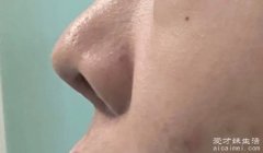 鼻子的整容方法有哪些 隆鼻、鼻翼缩小、鼻尖整形、鼻孔整形等