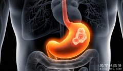 胃癌的五大早期症状是什么 胃部不适、食欲减退、黑便、饱胀、贫血
