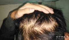 顶头发稀少怎样植发 健康的毛囊移植到另一个头顶