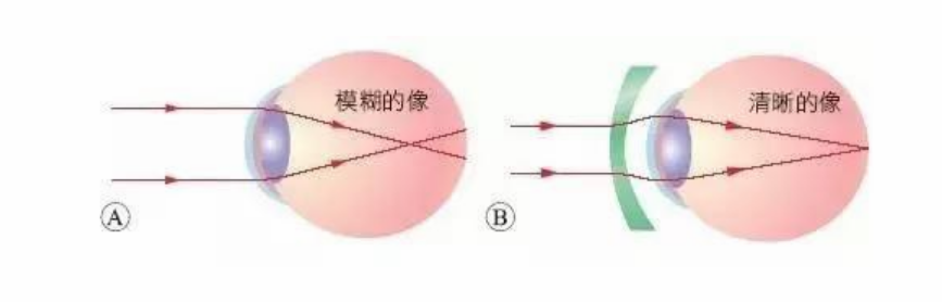 OK镜所有孩子都适合戴吗 OK镜哪里可以买