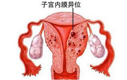 如何诊断子宫内膜异位症?什么是子宫内膜异位症？