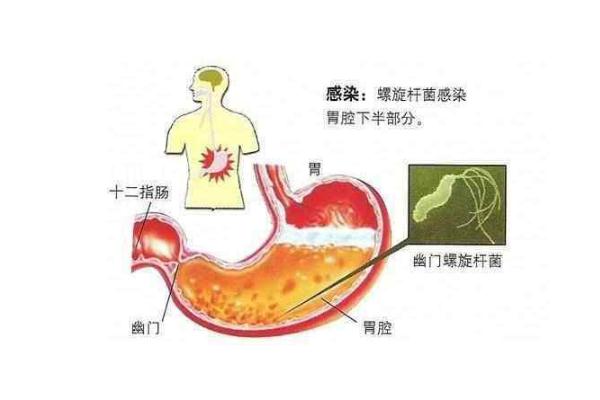 幽门螺杆菌要空腹查吗 幽门螺杆菌要注意什么