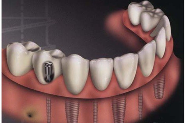 种植牙齿的危害 种植牙齿的副作用