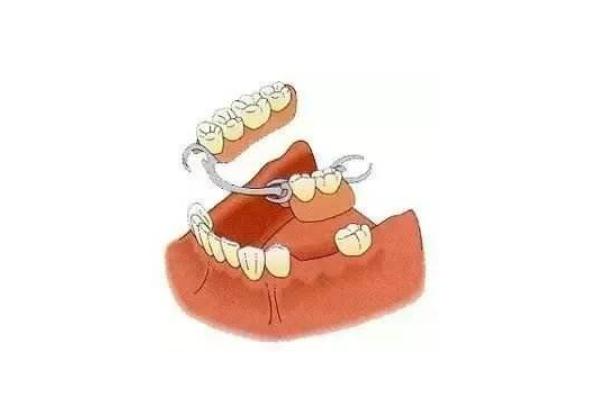 镶牙的寿命是多长时间 镶牙的危害