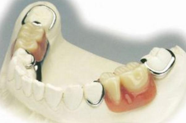 镶牙的寿命是多长时间 镶牙的危害