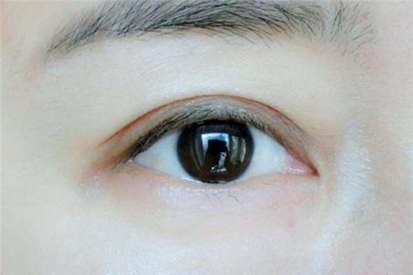 长期贴双眼皮贴有什么危害 双眼皮贴有几种类型