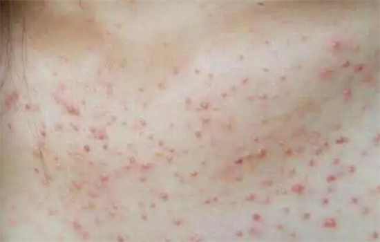 床上螨虫咬的症状图片，红疹发痒看上去吓人(皮肤会有很大的变化)