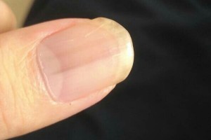 指甲竖纹当心三大疾病 消化方面不好(肝脏方面的疾病)
