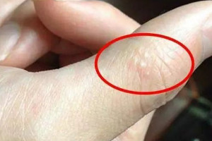 手指起小水泡要警惕了，可能是这4种疾病引起的(脚气/皮炎)