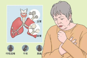 咳嗽出现这些症状要警惕肺炎，发热/呼吸困难/黄痰/胸痛