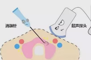 甲状腺消融针多少钱一支医保报销吗，2000-4000元左右